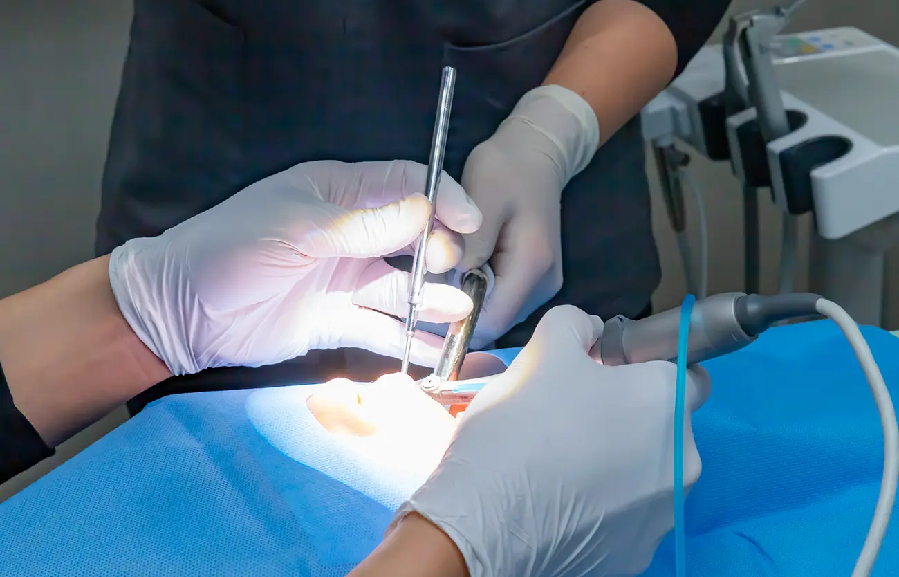 インプラント手術