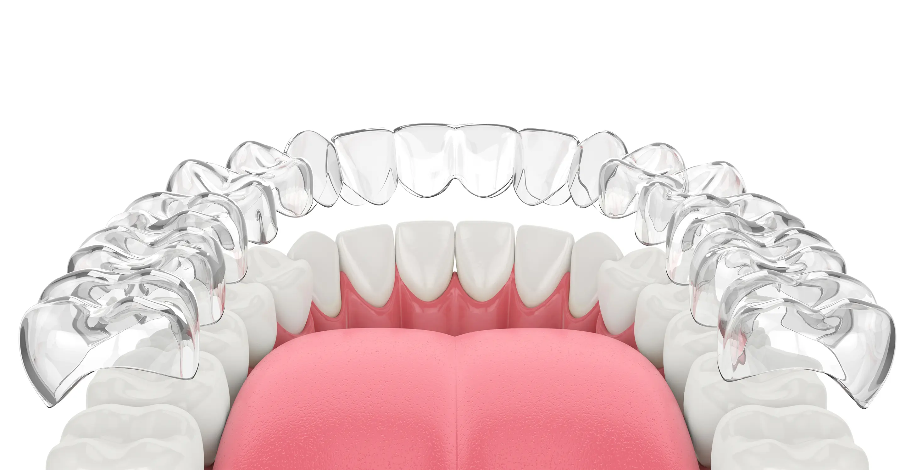 歯列矯正×インプラント