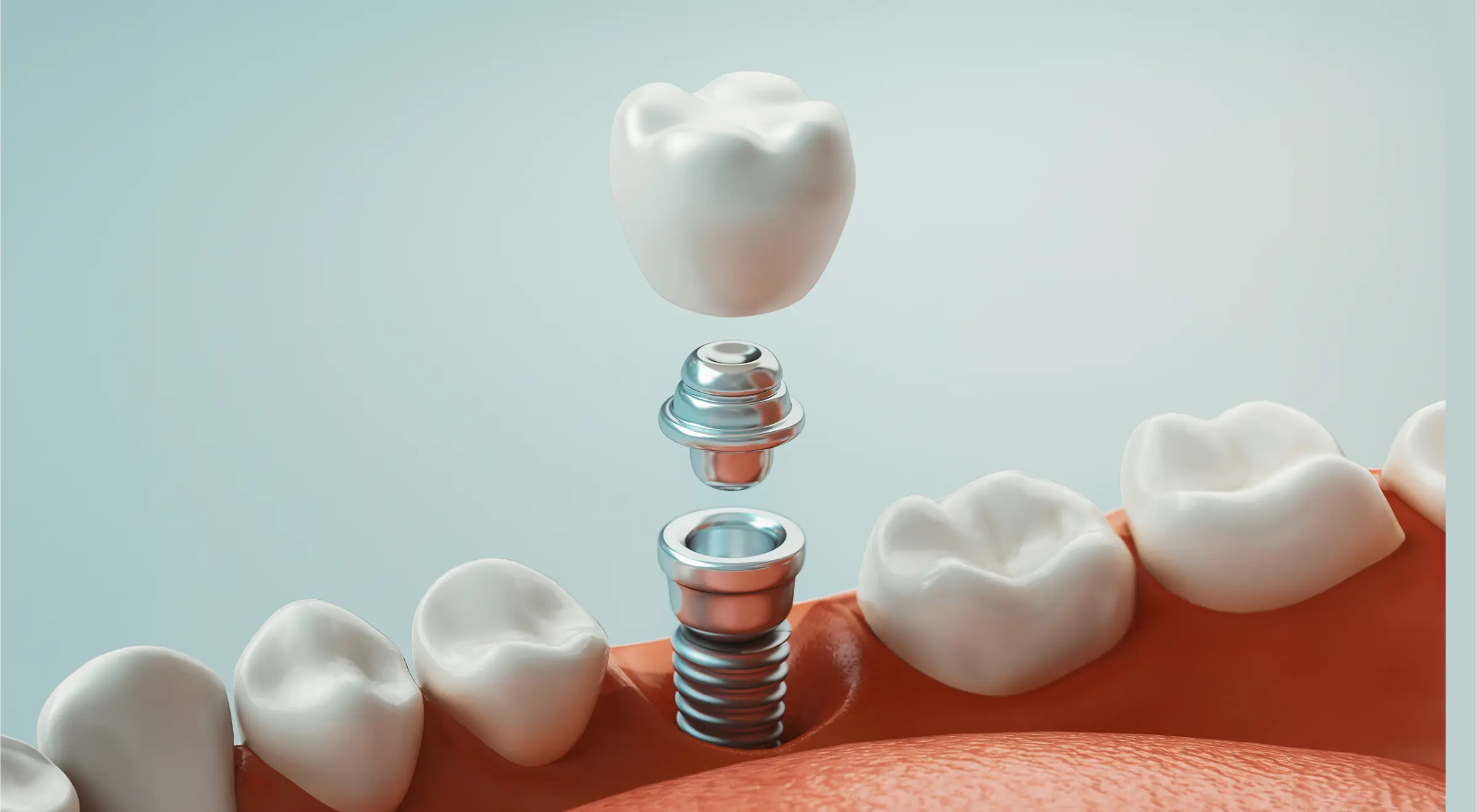 世界的に信頼性と安全性の高いストローマンインプラントを採用