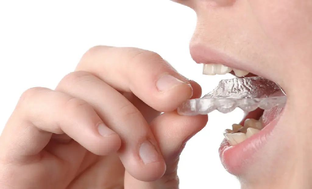 マウスピース矯正（インビザラインファースト）